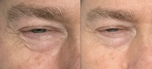eye wrinkle filler day 15ml