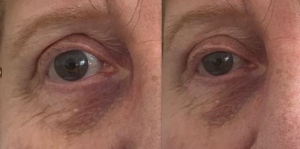 eye wrinkle filler day 15ml
