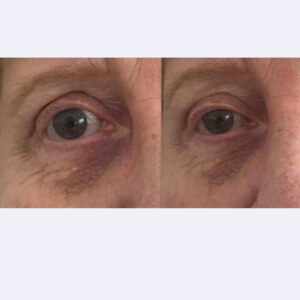 eye wrinkle filler night 15ml